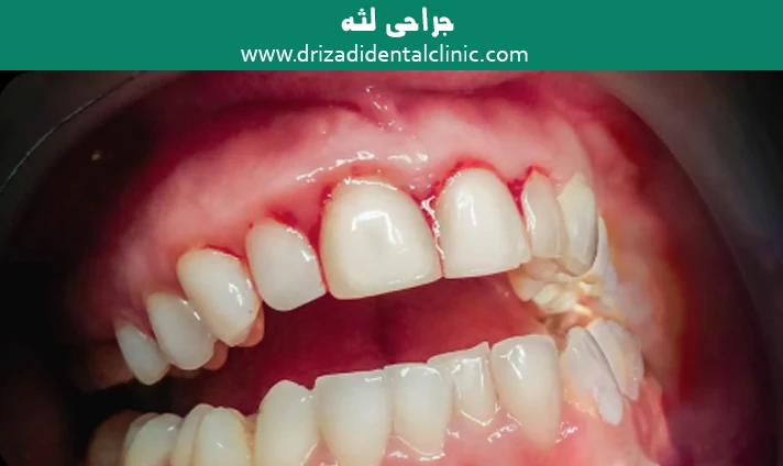 جراحی لثه