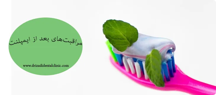 مراقبت بعد از ایمپلنت