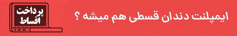ایمپلنت دندان قسطی