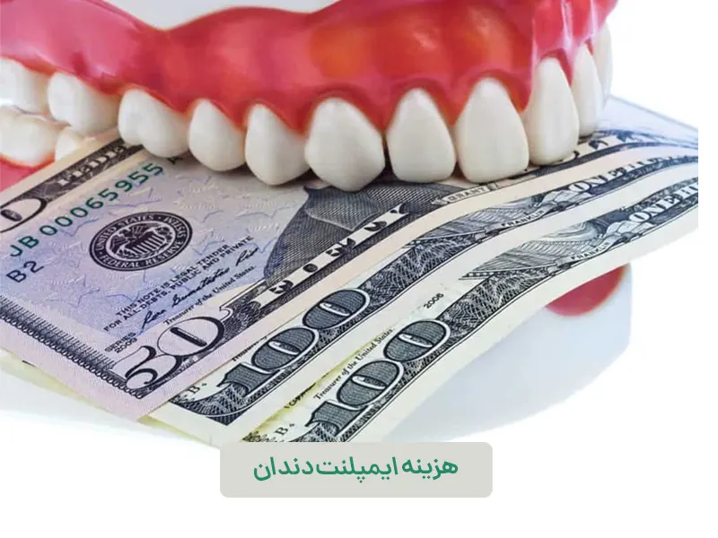هزینه ایمپلنت