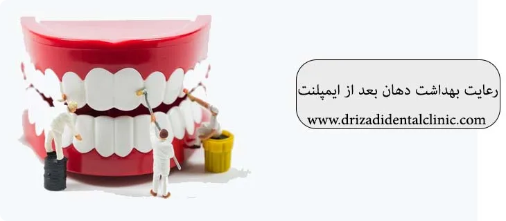 عوارض ایمپلنت دندان چیست