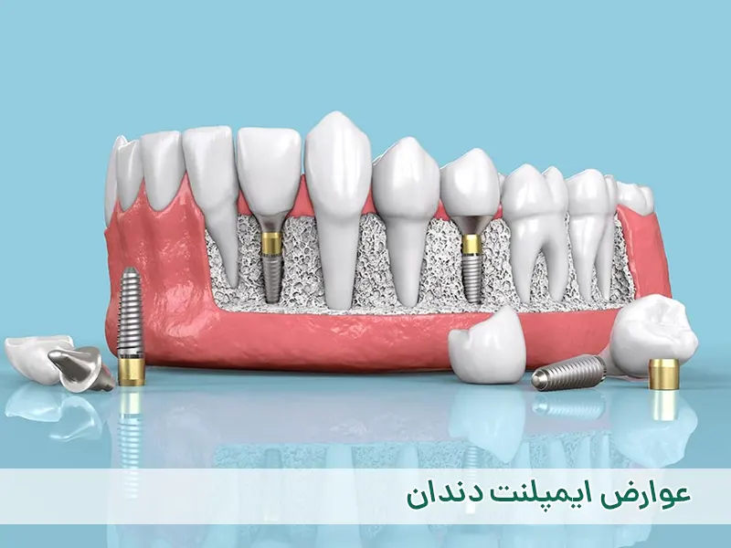 عوارض ایمپلنت دندان