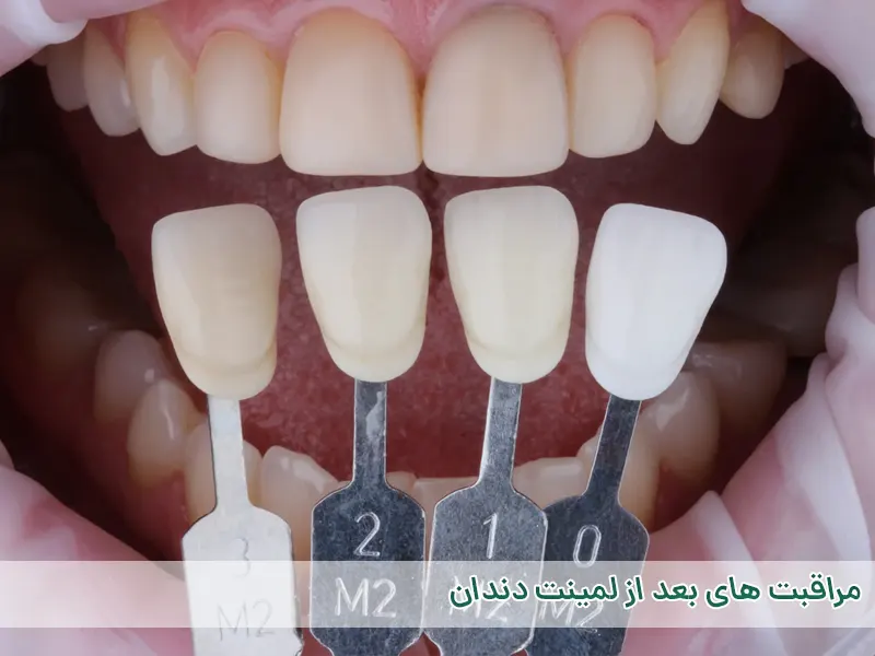 مراقبت های بعد لمینت دندان
