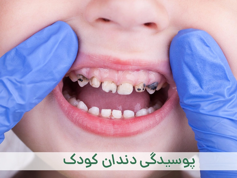 پوسیدگی دندان کودک