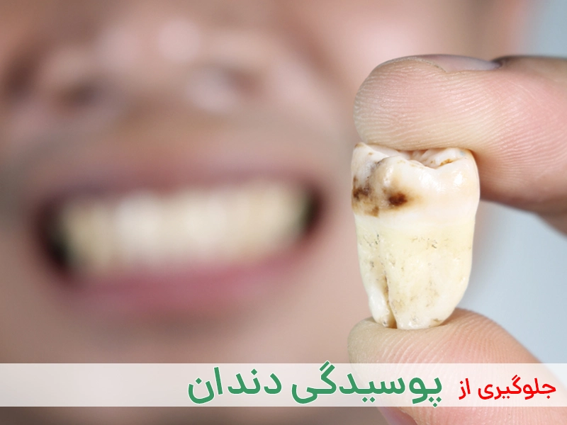 پوسیدگی دندان