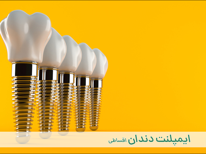 ایمپلنت دندان اقصاطی