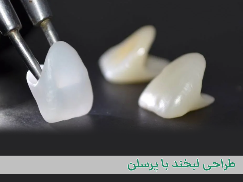 طراحی لبخند پرسلن