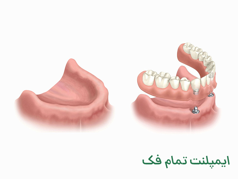 ایمپلنت تمام فک