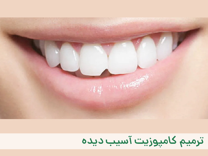 ترمیم کامپوزیت آسیب دیده