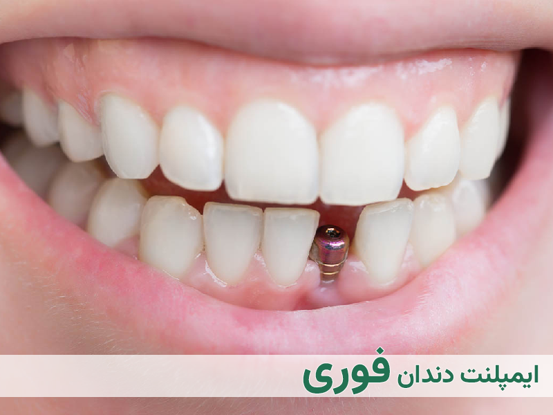 ایمپلنت دندان فوری