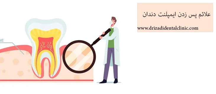 علائم پس زدن ایمپلنت چیست