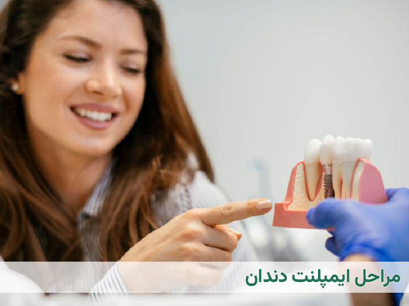 مراحل ایمپلنت دندان
