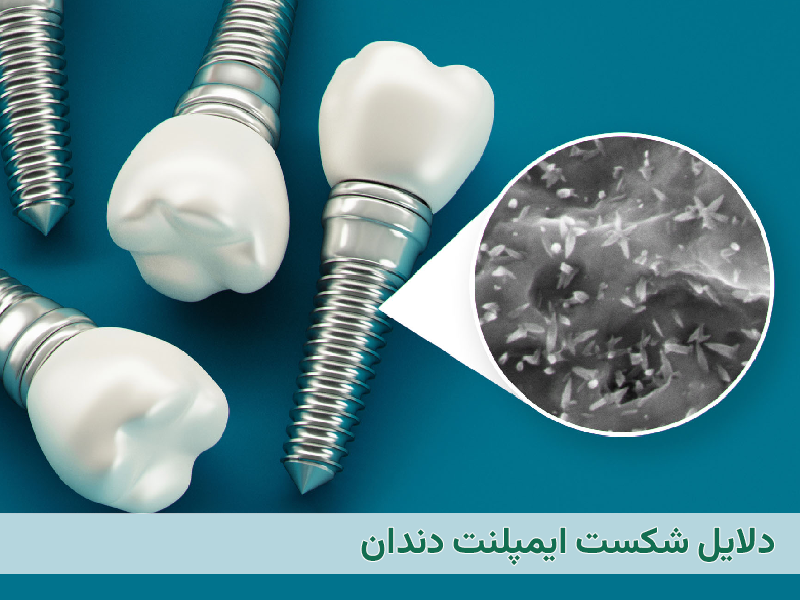 پس زدن ایمپلنت دندان