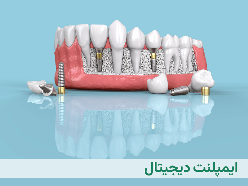 ایمپلنت دیجیتال