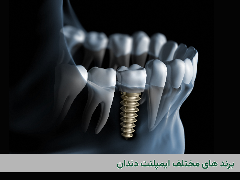 برندهای ایمپلنت