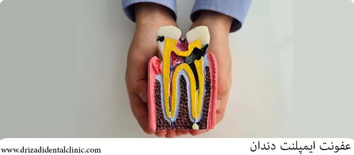 عفونت کاشت دندان