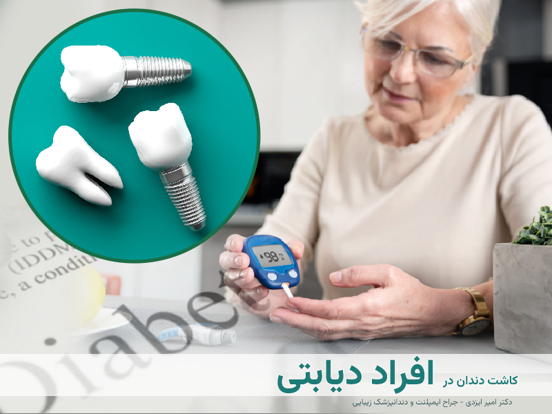 کاشت دندان در دیابتی ها