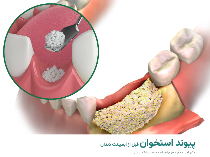پیوند استخوان قبل ایمپلنت