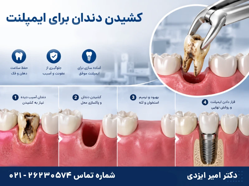 کشیدن دندان برای ایمپلنت