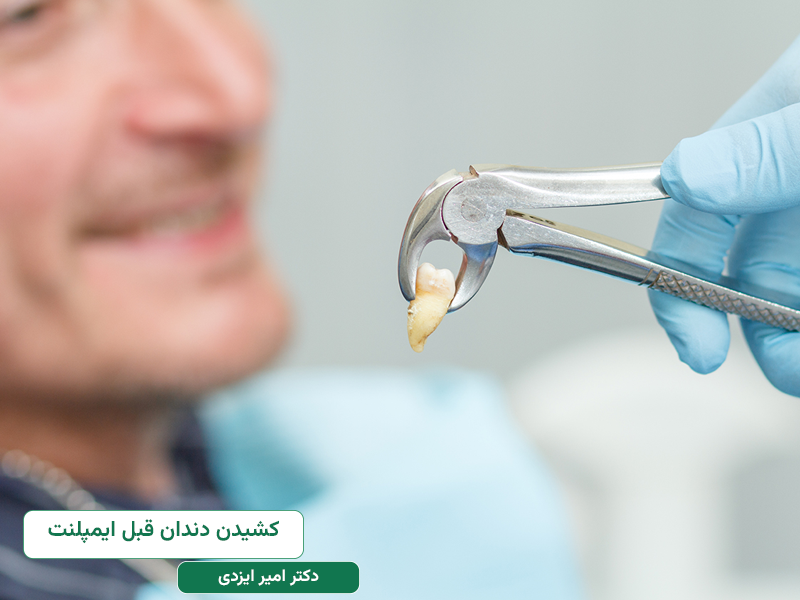کشیدن دندان قبل از ایمپلنت