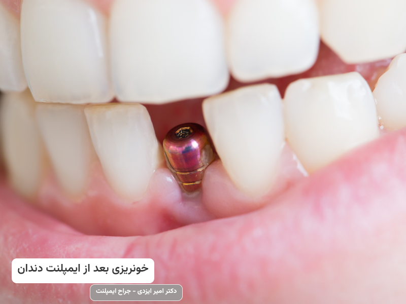 خونریزی بعد از ایمپلنت دندان