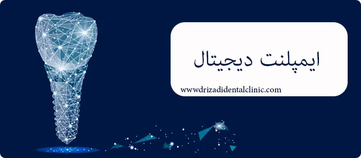 ایمپلنت دیجیتال چیست