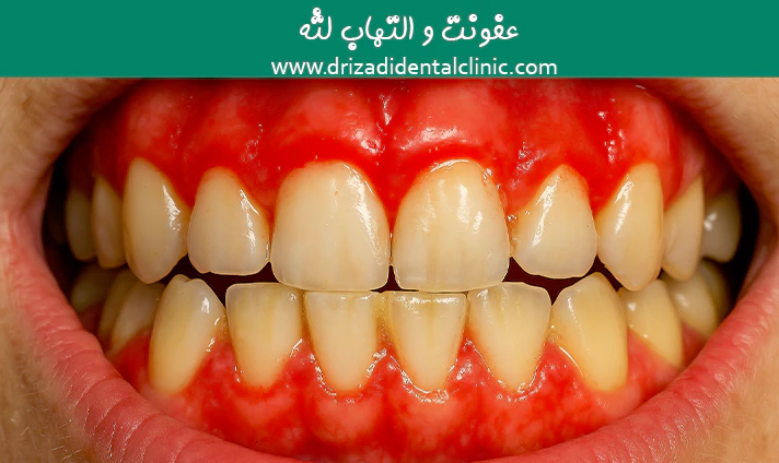 عفونت و التهاب لثه