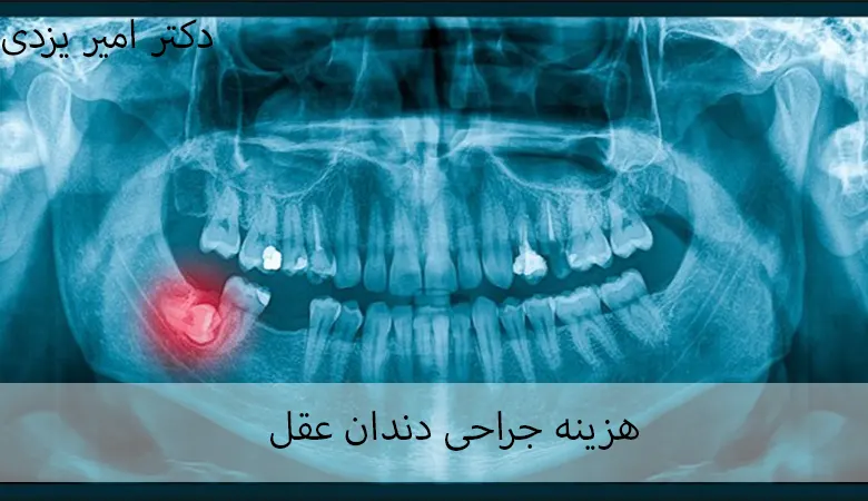 هزینه جراحی دندان عقل