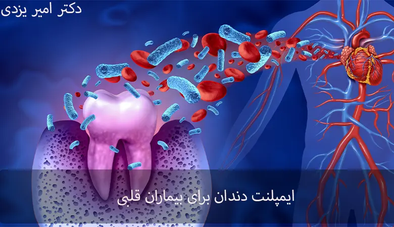 ایمپلنت دندان برای بیماران قلبی