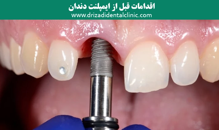 اقدامات قبل از ایمپلنت دندان