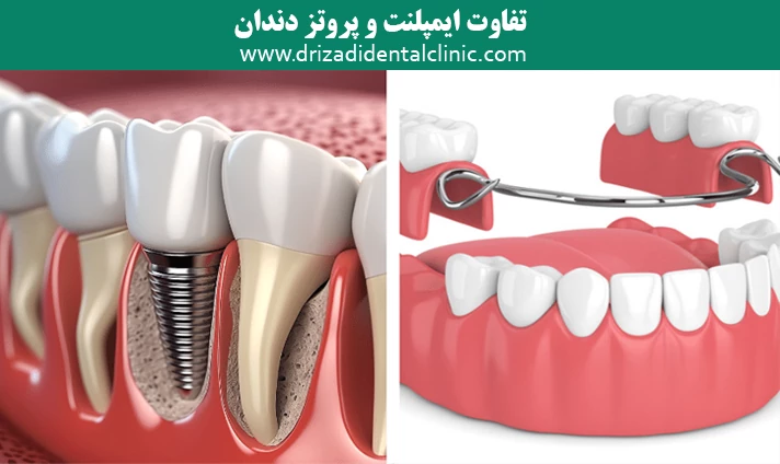 تفاوت ایمپلنت و پروتز دندان