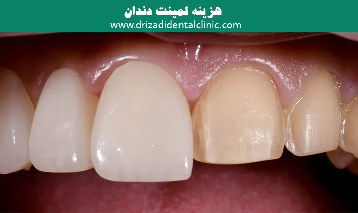 هزینه لمینت دندان