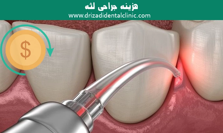 هزینه جراحی لثه