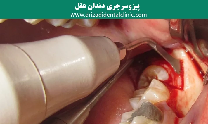 پیزوسرجری دندان عقل