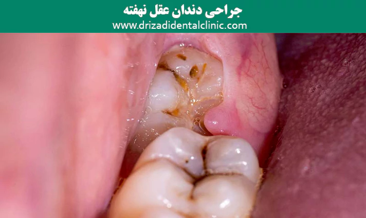 جراحی دندان عقل نهفته