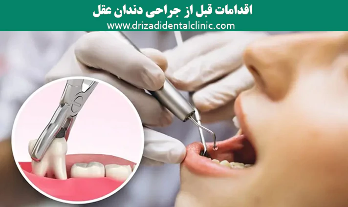 اقدامات قبل از جراحی دندان عقل