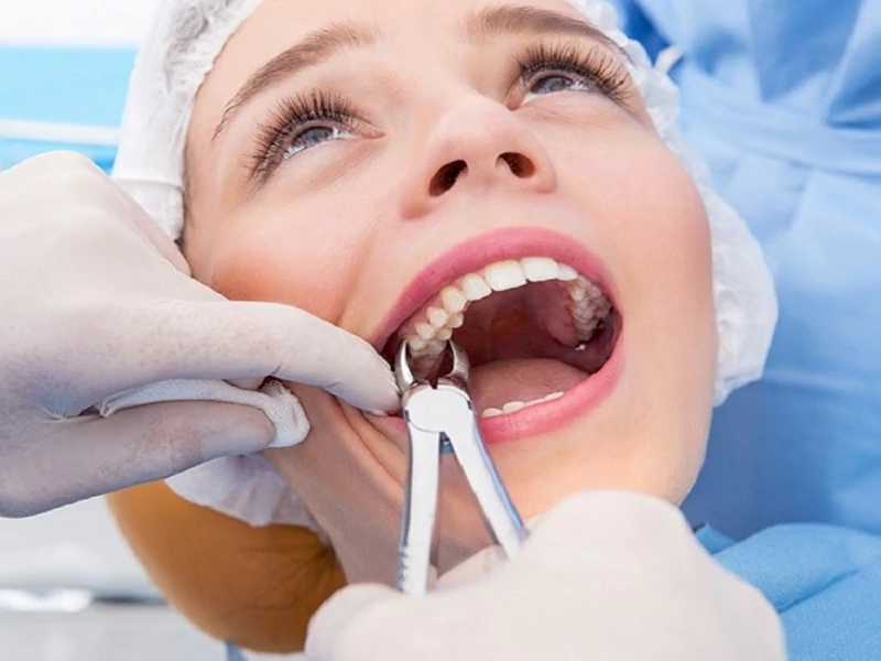 بعد از جراحی دندان عقل چه بخوریم؟