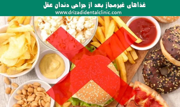 غذاهای غیرمجاز بعد از جراحی دندان عقل