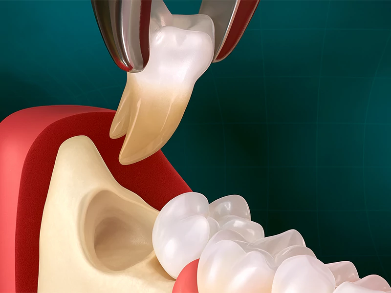 عوامل موثر بر طول دوره نقاهت جراحی دندان عقل