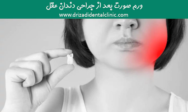 ورم صورت بعد از جراحی دندان عقل
