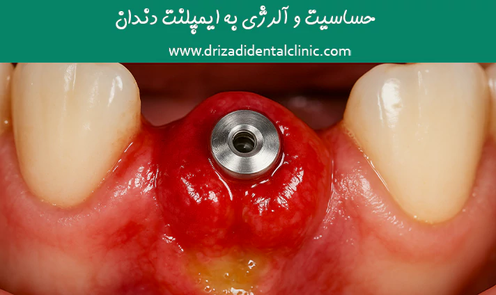 حساسیت و آلرژی به ایمپلنت دندان