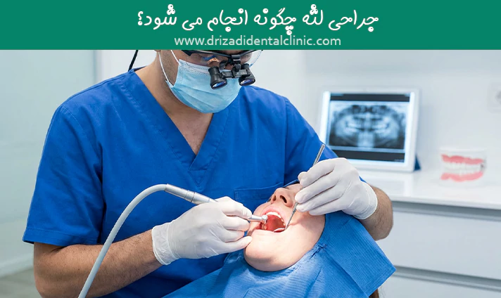 جراحی لثه چگونه انجام می شود؟