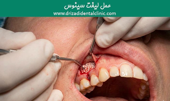 عمل لیفت سینوس