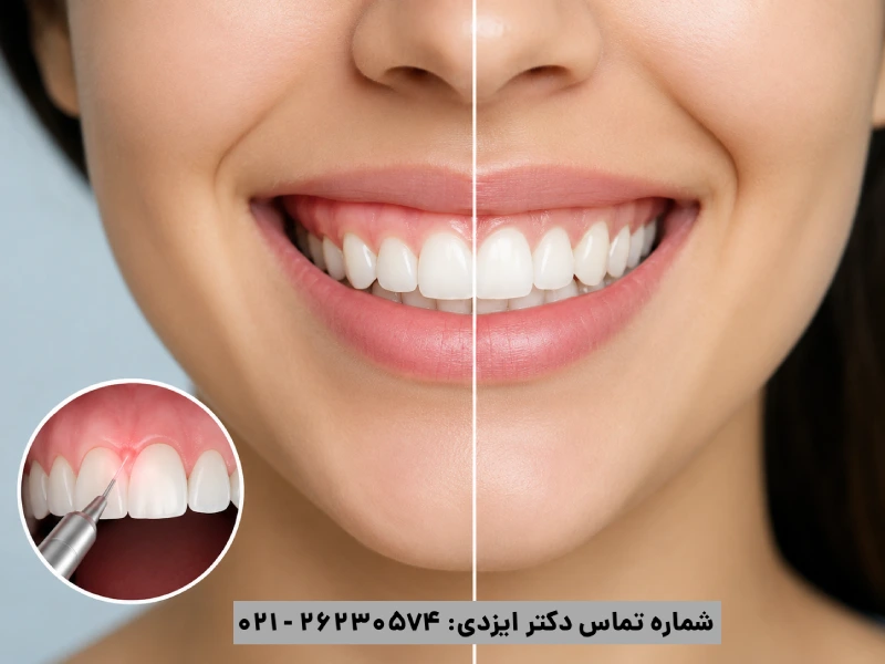 اصلاح لبخند لثه ای
