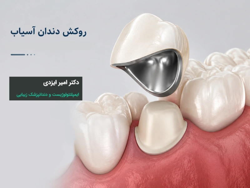 روکش دندان آسیاب