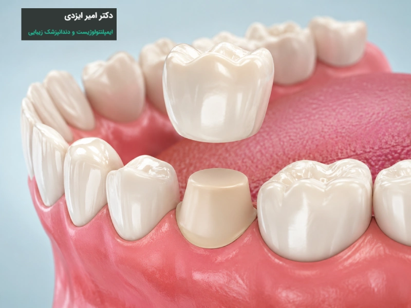 طول عمر روکش دندان