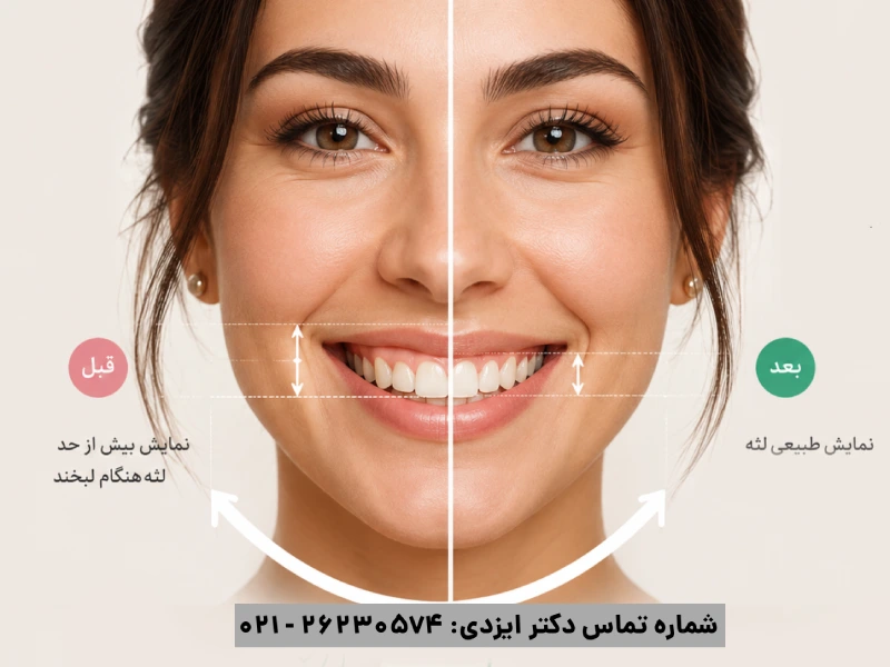 لبخند لثه ای