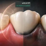 سیاه شدن لثه بعد از روکش