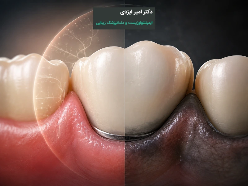 سیاه شدن لثه بعد از روکش