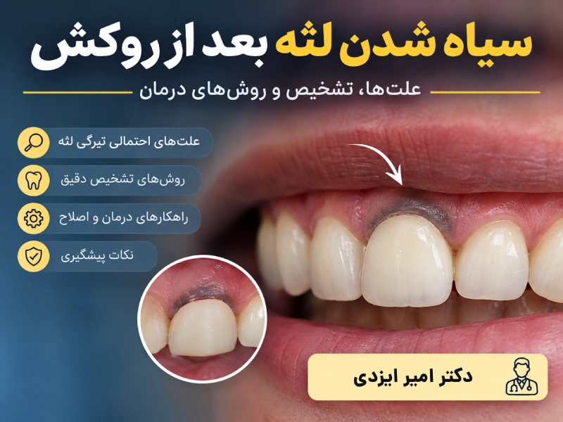 سیاه شدن لثه بعد از روکش